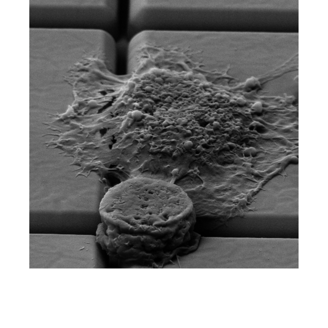 Breast cancer cell on ISFET array