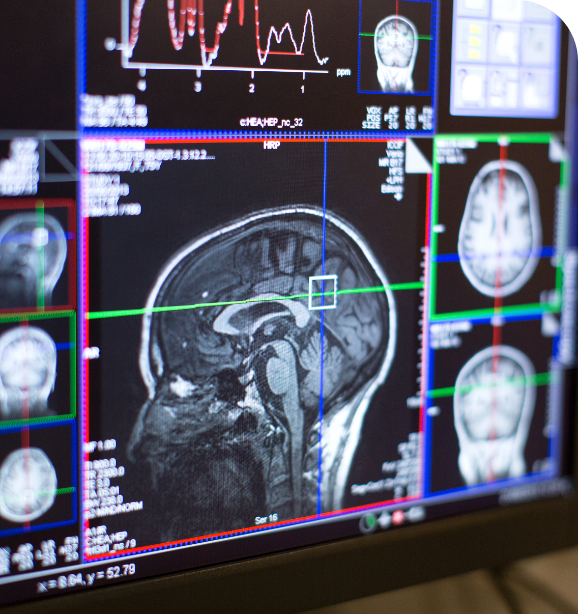 Clinical Brain scan at the Imaging Facility in the basement of the Wolfson Building at the Hammersmith Campus