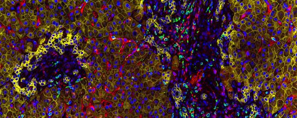 Detecting immune cell populations in a liver biopsy by Dr Mateus Crespo Dr Bora Gurel, Ana Ferreira, Rita Pereira, and Professor Johann de Bono, Division of Clinical Studies.