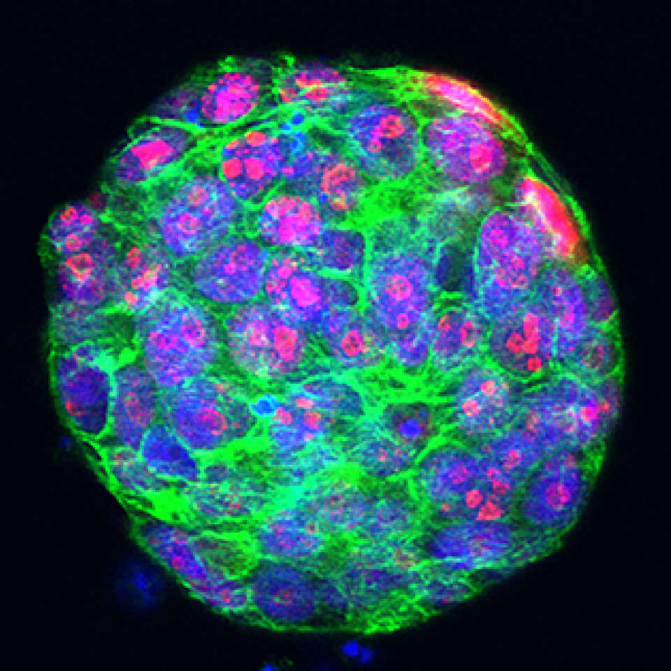 Proliferating cells in a tumour organoid of triple negative breast-cancer